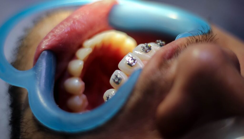 Home Dental Care Tips for Braces Wearers