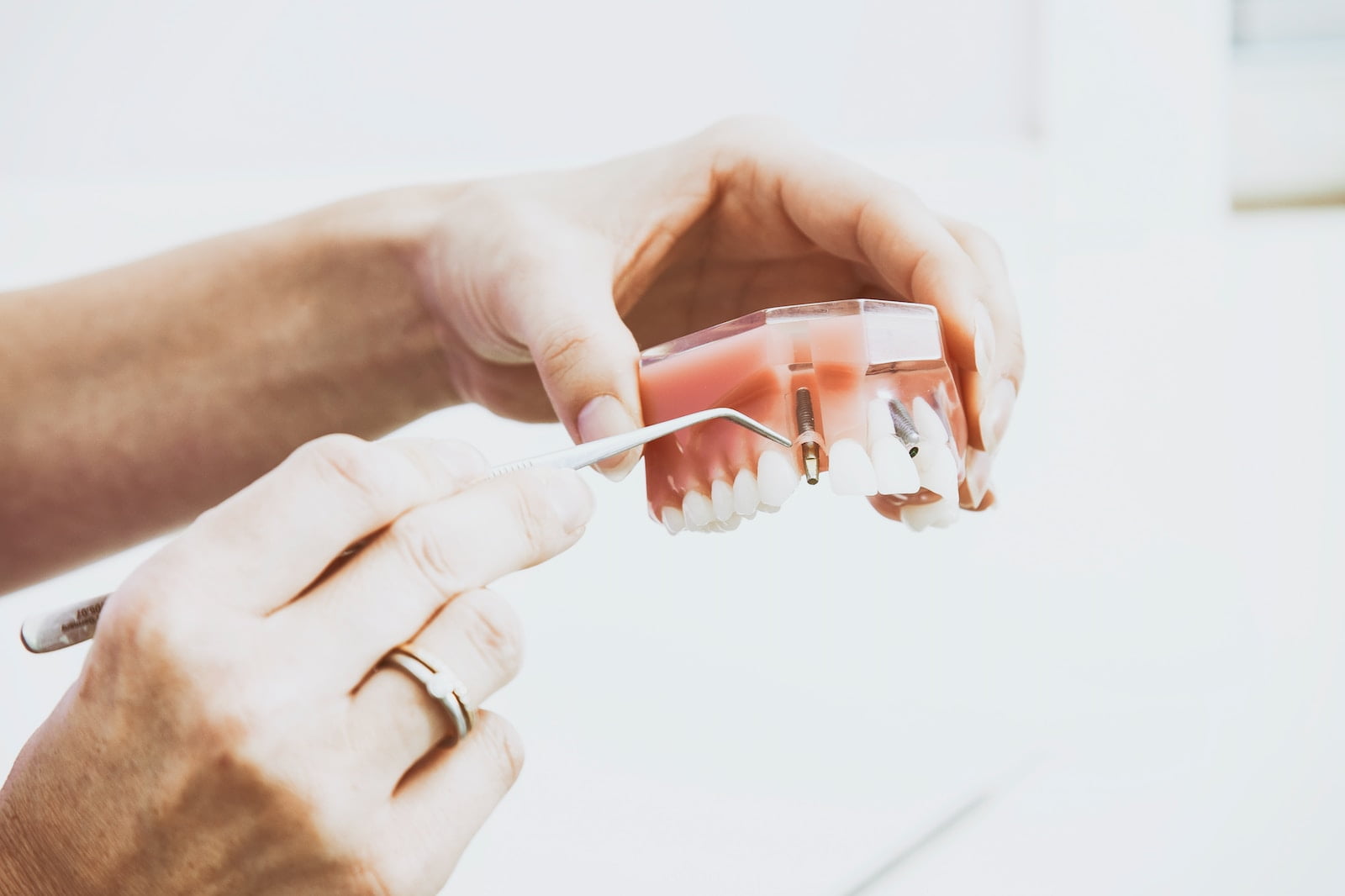 Can a Dental Bridge Be Removed and Recemented?