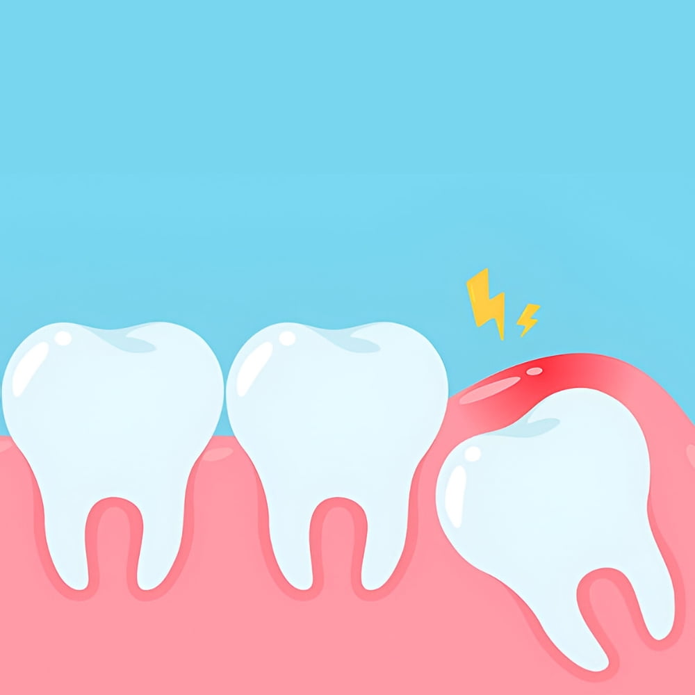 Gum Irritation Caused by Wisdom Teeth