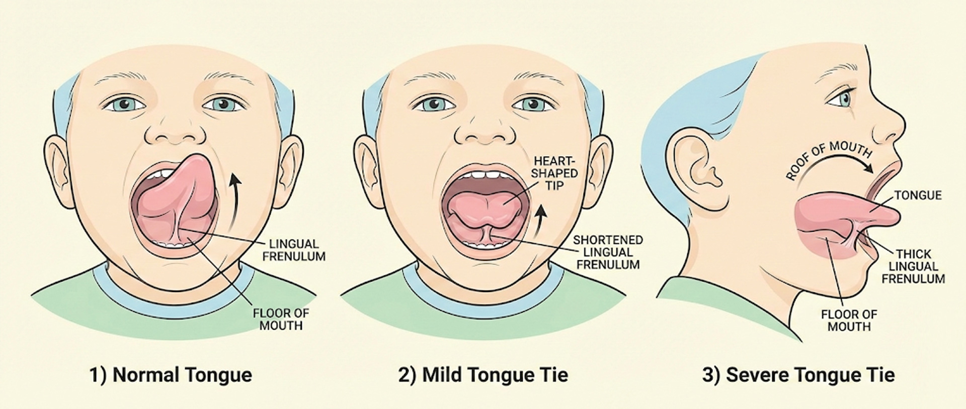 Normal Tongue vs Tongue Tie – Mild and Severe Ankyloglossia Explained with Tongue Movement Comparison Medical illustration showing normal tongue, mild tongue tie, and severe tongue tie with lingual frenulum position and restricted tongue movement