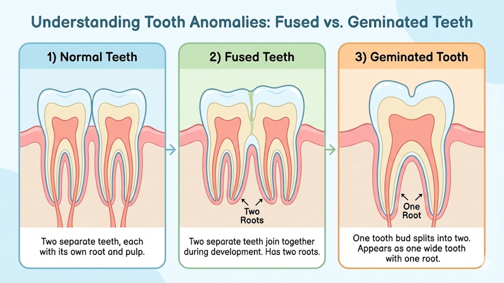Fused vs Geminated Teeth Explained – Difference Between Normal, Fused, and Geminated Tooth Anomalies Dental illustration comparing normal teeth, fused teeth with two roots, and geminated tooth showing one wide crown and single root